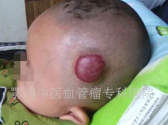 血管瘤图片是什么原理_血管瘤是什么样子的图