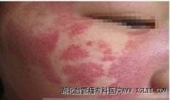 血管瘤是怎么形成的