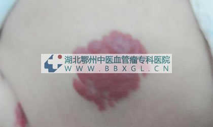 手部草莓状血管瘤图片