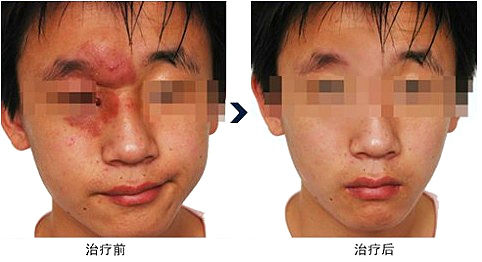 艾滋病人脸上有斑吗 0S44021M-3.jpg