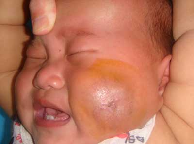 婴幼儿血管瘤
