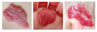 什么是草莓状血管瘤？