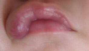 嘴唇血管瘤都有哪些症状?