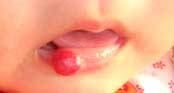 嘴唇草莓状血管瘤图片