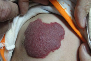 草莓状血管瘤图片