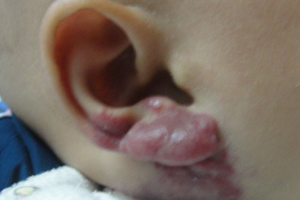 耳朵混合型血管瘤图片