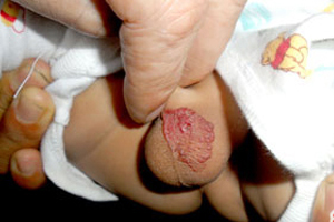 幼儿阴部血管瘤图片
