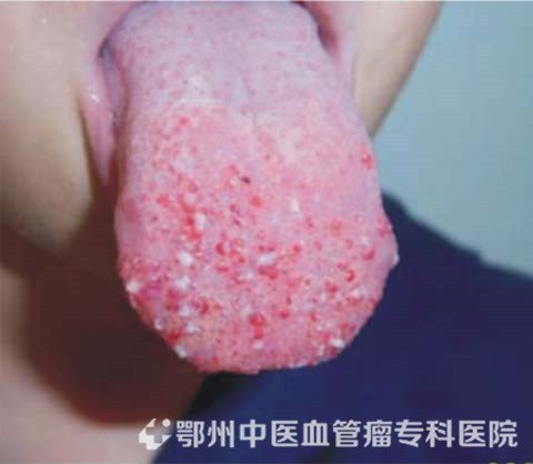 舌部淋巴血管瘤图片