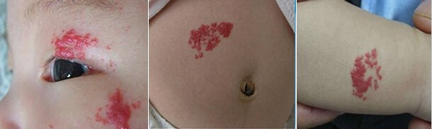 宝宝长红点是血管瘤吗?